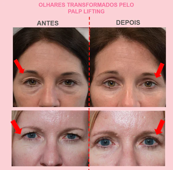 Comparativo: Adesivos vs. Cirurgia para Pálpebra Caída