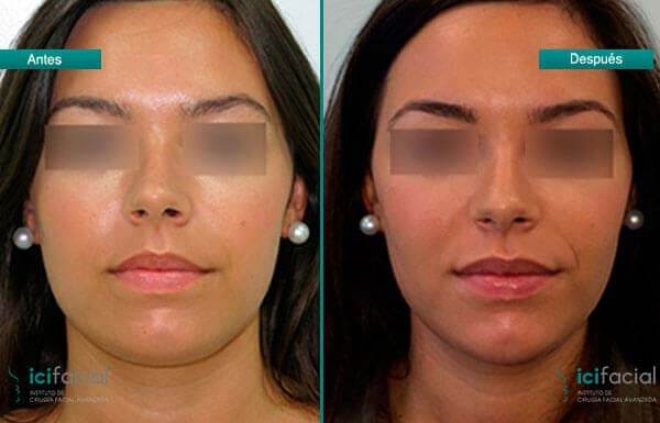 Escolhendo o profissional certo para sua bichectomia - inspiração 2