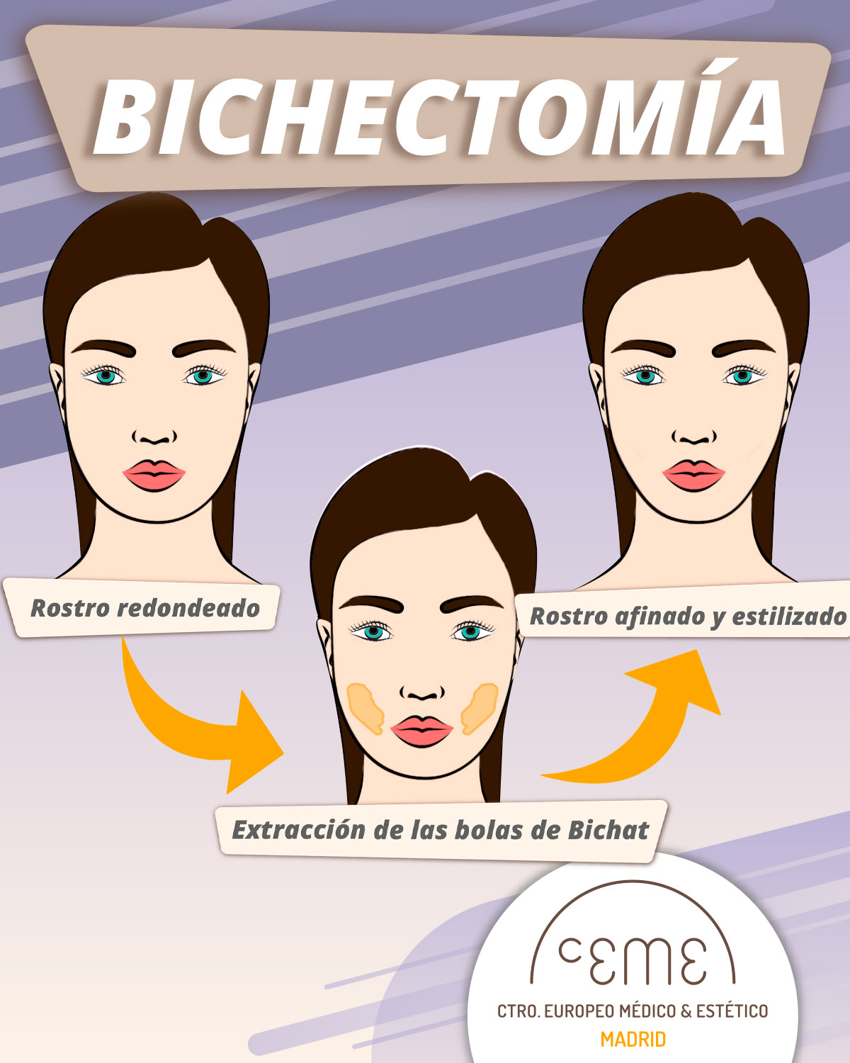 Quem são os candidatos ideais para a bichectomia? - inspiração 1
