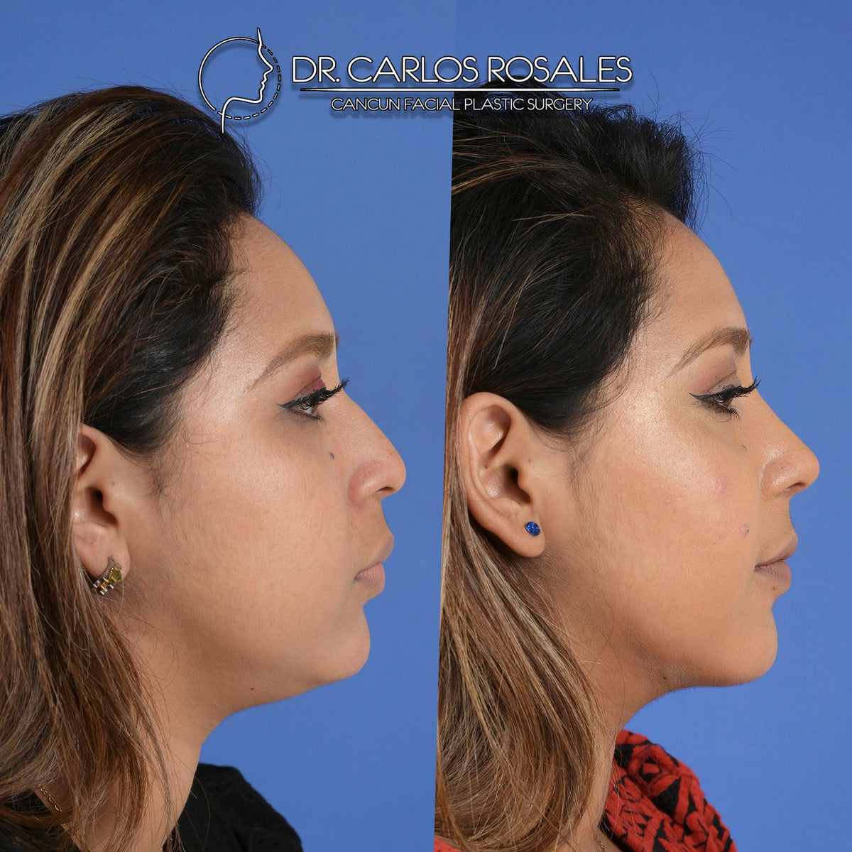 Como é o pré-operatório da bichectomia? - inspiração 1