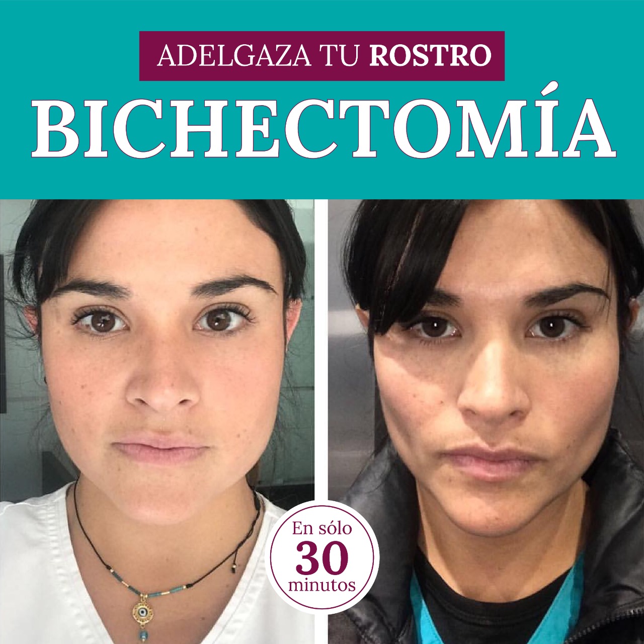 Cuidados essenciais no pós-operatório da bichectomia - inspiração 1