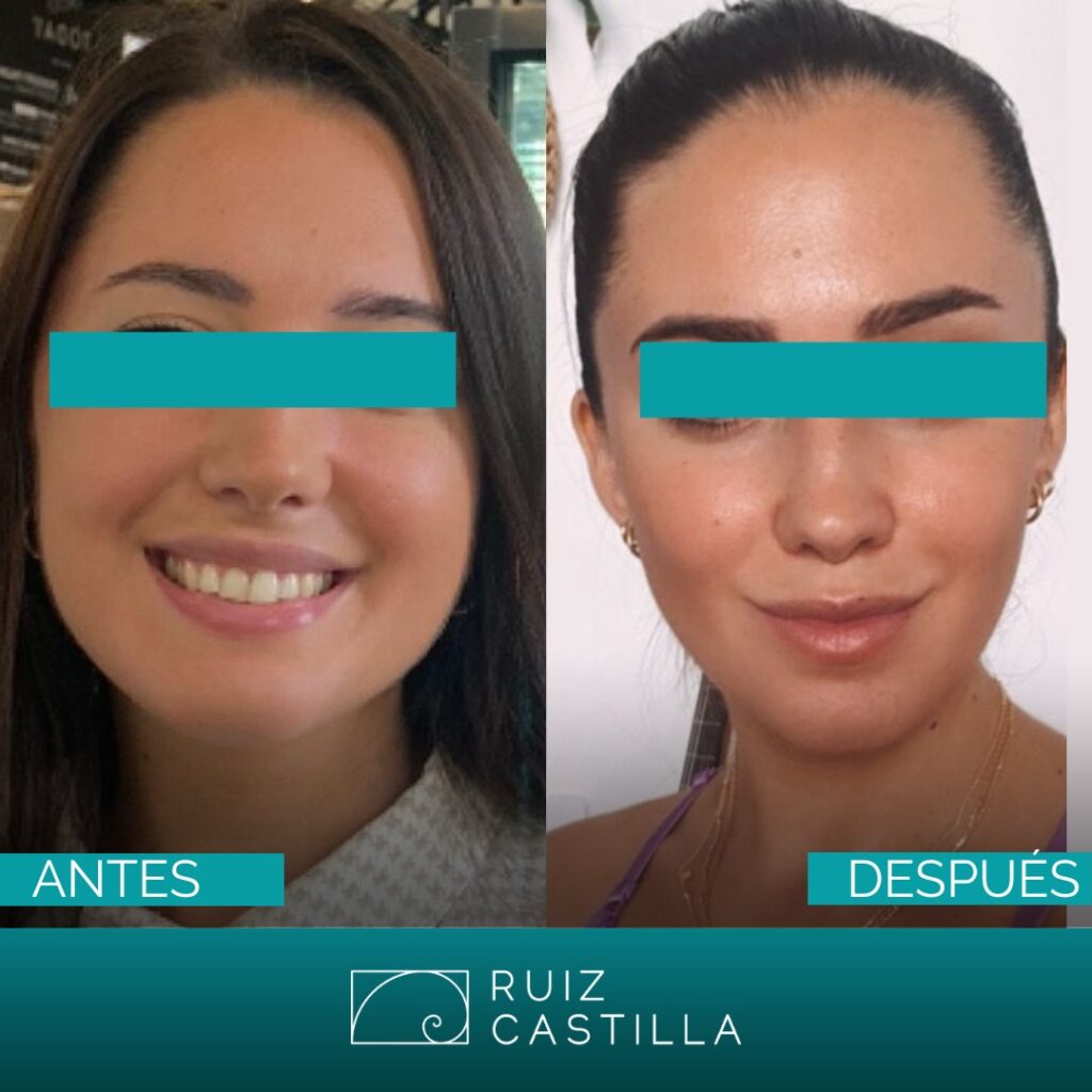 Riscos e possíveis complicações da bichectomia - inspiração 1