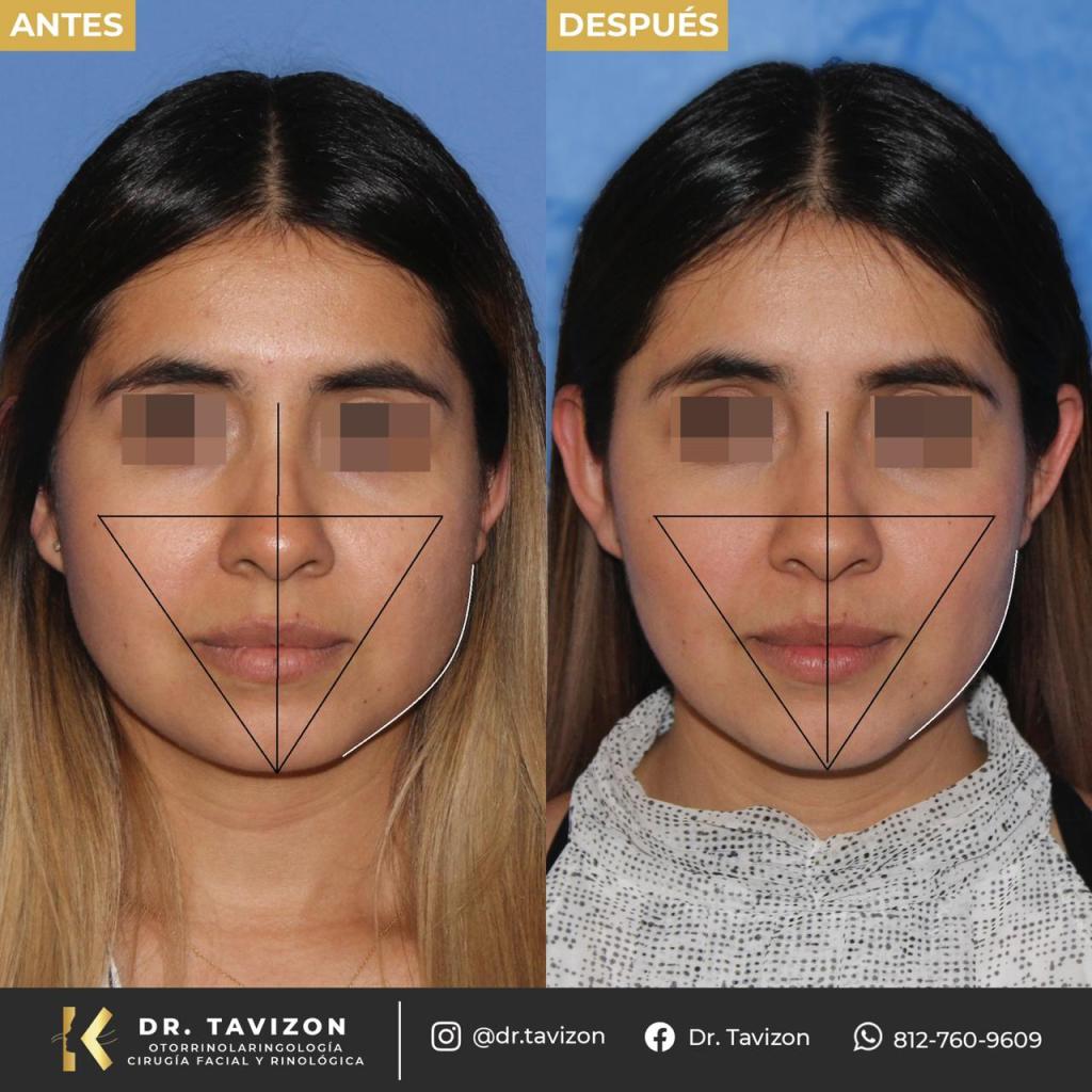 Diferença entre bichectomia e outros procedimentos faciais - inspiração 1