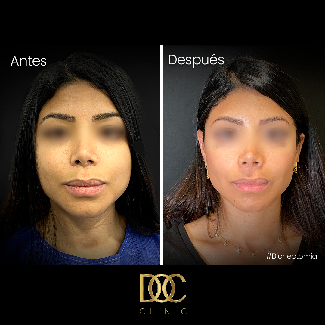 Mitos e verdades sobre a remoção das bolas de Bichat - inspiração 1