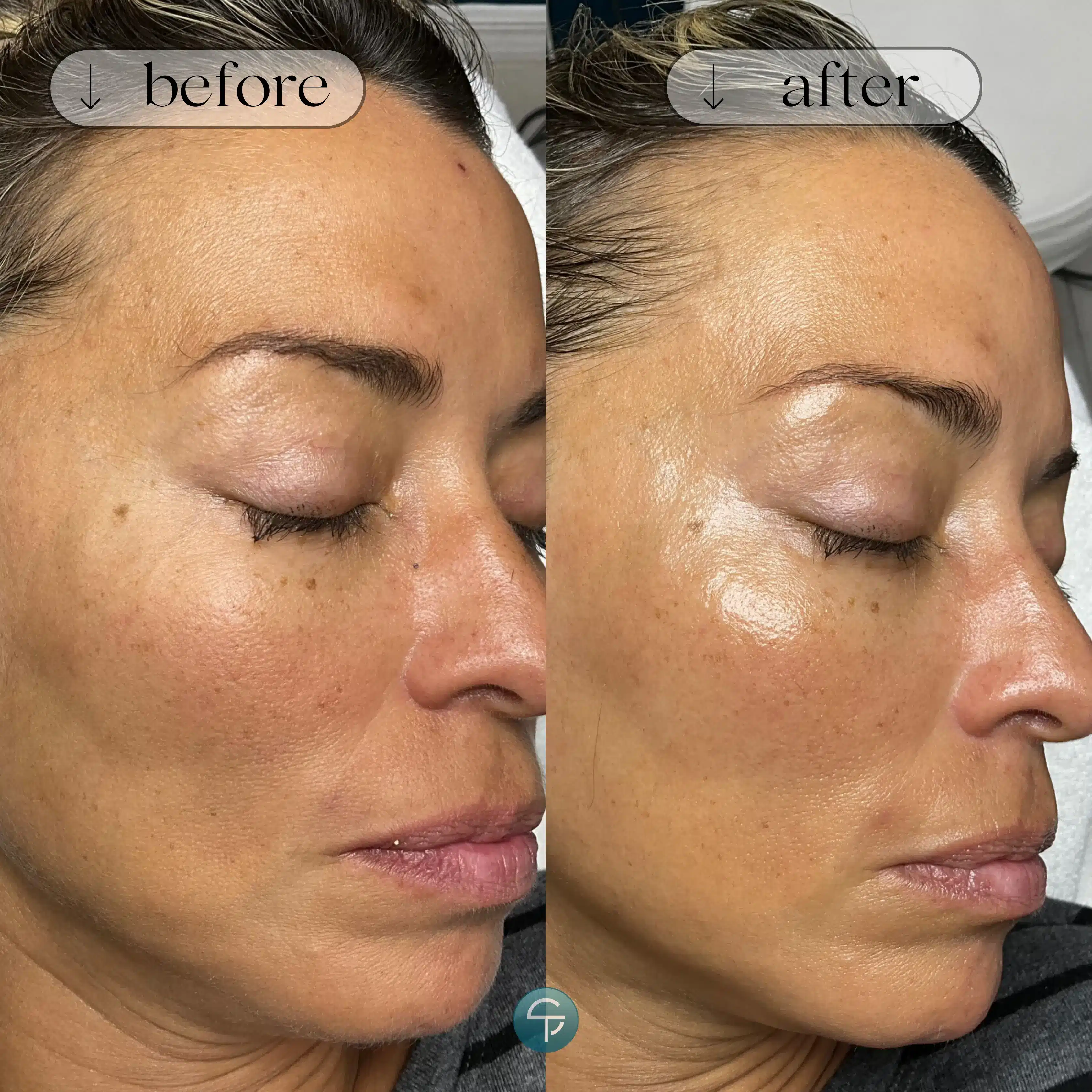 Dermaplaning vs. Microagulhamento: Qual a diferença?