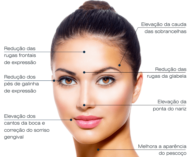 Áreas de Aplicação Comuns para Botox - inspiração 1