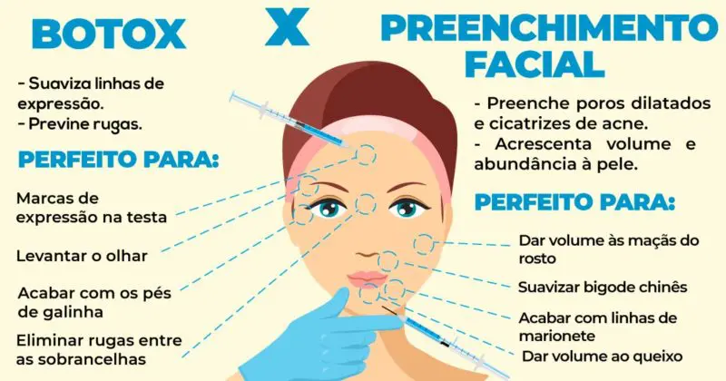 Áreas de Aplicação Comuns para Botox - inspiração 2