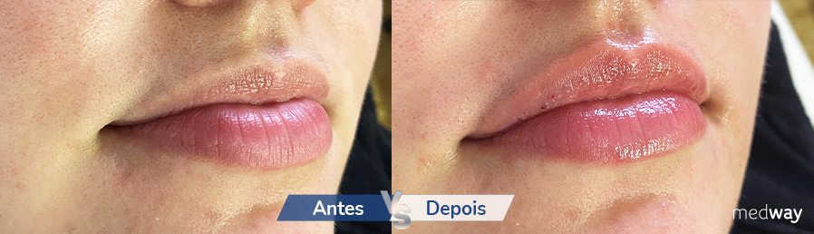 Onde o Preenchimento Faz a Diferença: Lábios e Maçãs do Rosto - inspiração 2