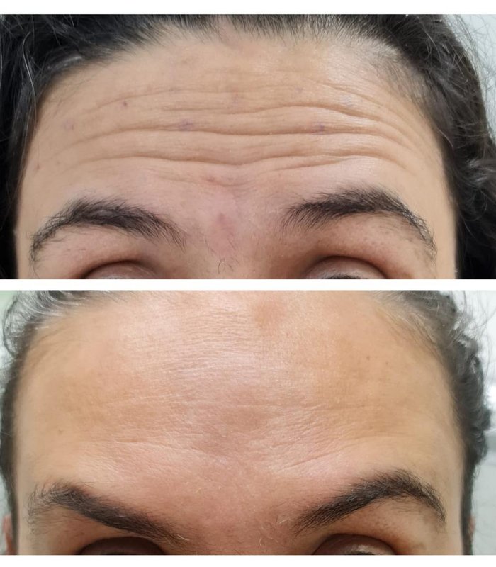 Diferenças na Duração dos Efeitos: O Que Esperar - inspiração 2