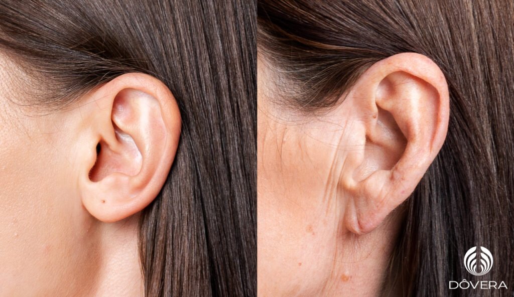 preenchimento de lóbulo de orelha