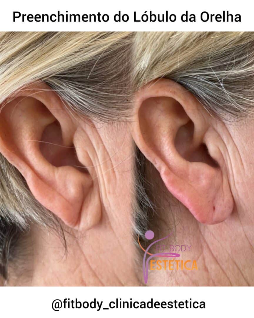 Como o preenchimento de lóbulo melhora a sustentação de brincos