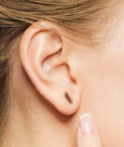 Recuperação Pós-Preenchimento de Lóbulo: O que esperar?