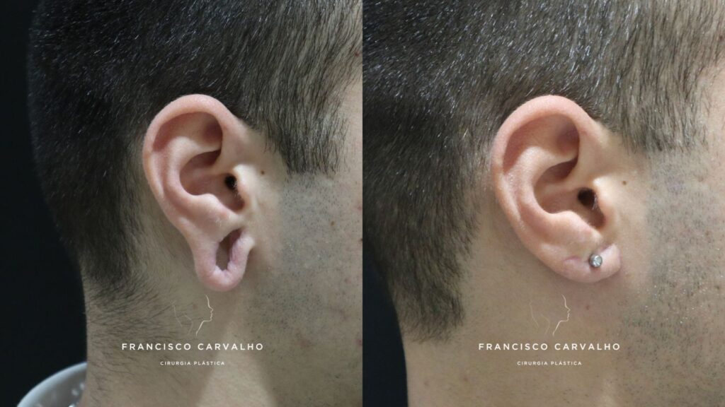 Ácido Hialurônico vs. Outros Preenchedores para Orelhas