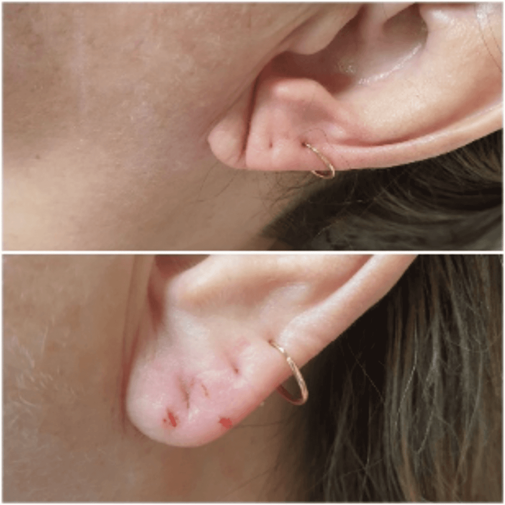 Ácido Hialurônico vs. Outros Preenchedores para Orelhas