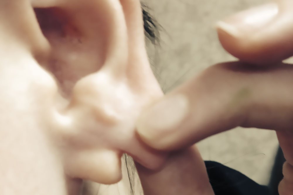 Diferenças Cruciais: Preenchimento de Lóbulo vs. Lobuloplastia