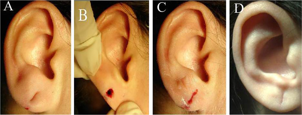 Quem é o Candidato Ideal para o Preenchimento de Lóbulo?
