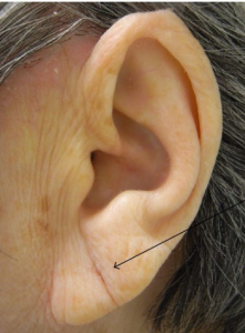 Mitos e Verdades sobre o Preenchimento de Lóbulo da Orelha