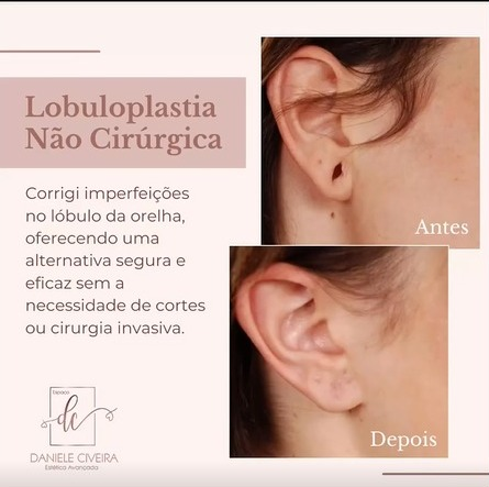 preenchimento de lóbulo de orelha