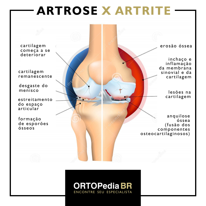 Principais Sintomas da Artrite: Dor, Inchaço e Rigidez Matinal - inspiração 2