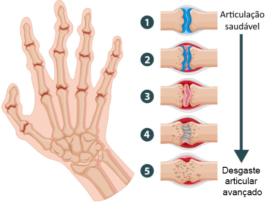Causas da Artrite: Doenças Autoimunes, Infecções e Predisposição Genética - inspiração 1