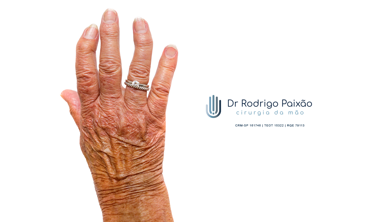 Causas da Artrite: Doenças Autoimunes, Infecções e Predisposição Genética - inspiração 2