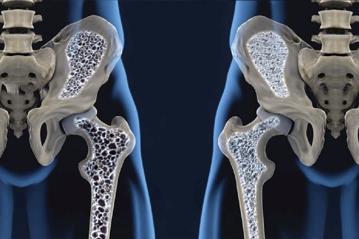 Tratamento para Artrose: Alívio da Dor e Preservação da Articulação - inspiração 2
