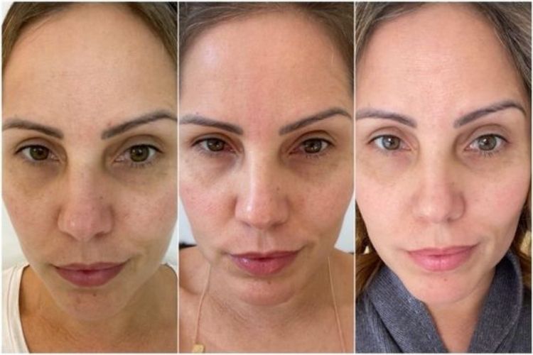 Ácido Azelaico: O Guia Completo para uma Pele Perfeita