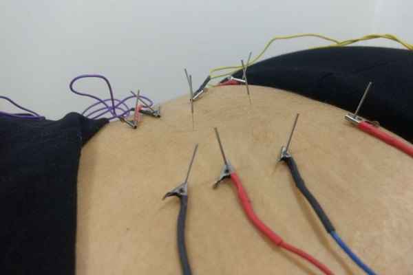 CNAE 8690-9/03: Tudo sobre a Atividade de Acupuntura