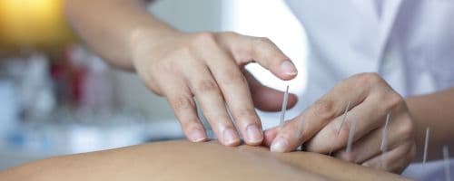 acupunturista pode ser mei