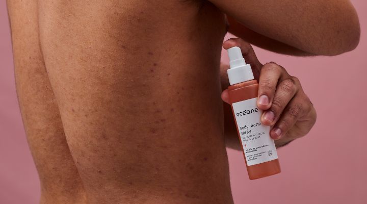 5 ideias de títulos:
1. Guia Completo de BHAs: Benefícios e Como Usar
2. Ácido Salicílico: O Segredo para uma Pele Livre de Acne
3. BHA vs. AHA: Qual o Melhor para o Seu Tipo de Pele?
4. Como Incorporar BHAs na Sua Rotina de Skincare
5. Desvendando os Beta-Hidroxiácidos: Tudo o que Você Precisa Saber