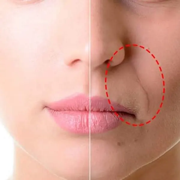 Ácido Hialurônico para Bigode Chinês: Guia Completo e Resultados