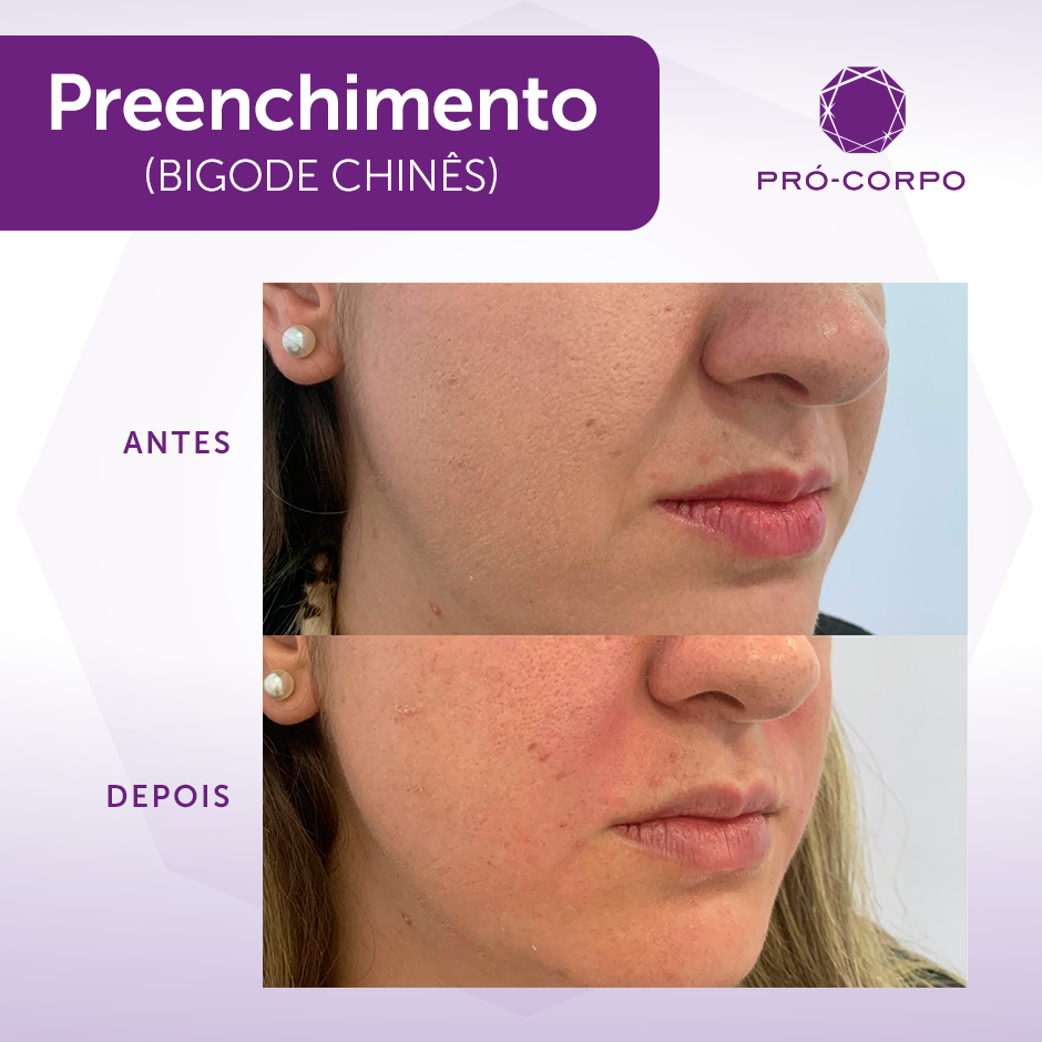 Prevenção do Bigode Chinês: Hábitos Diários Essenciais para uma Pele Jovem