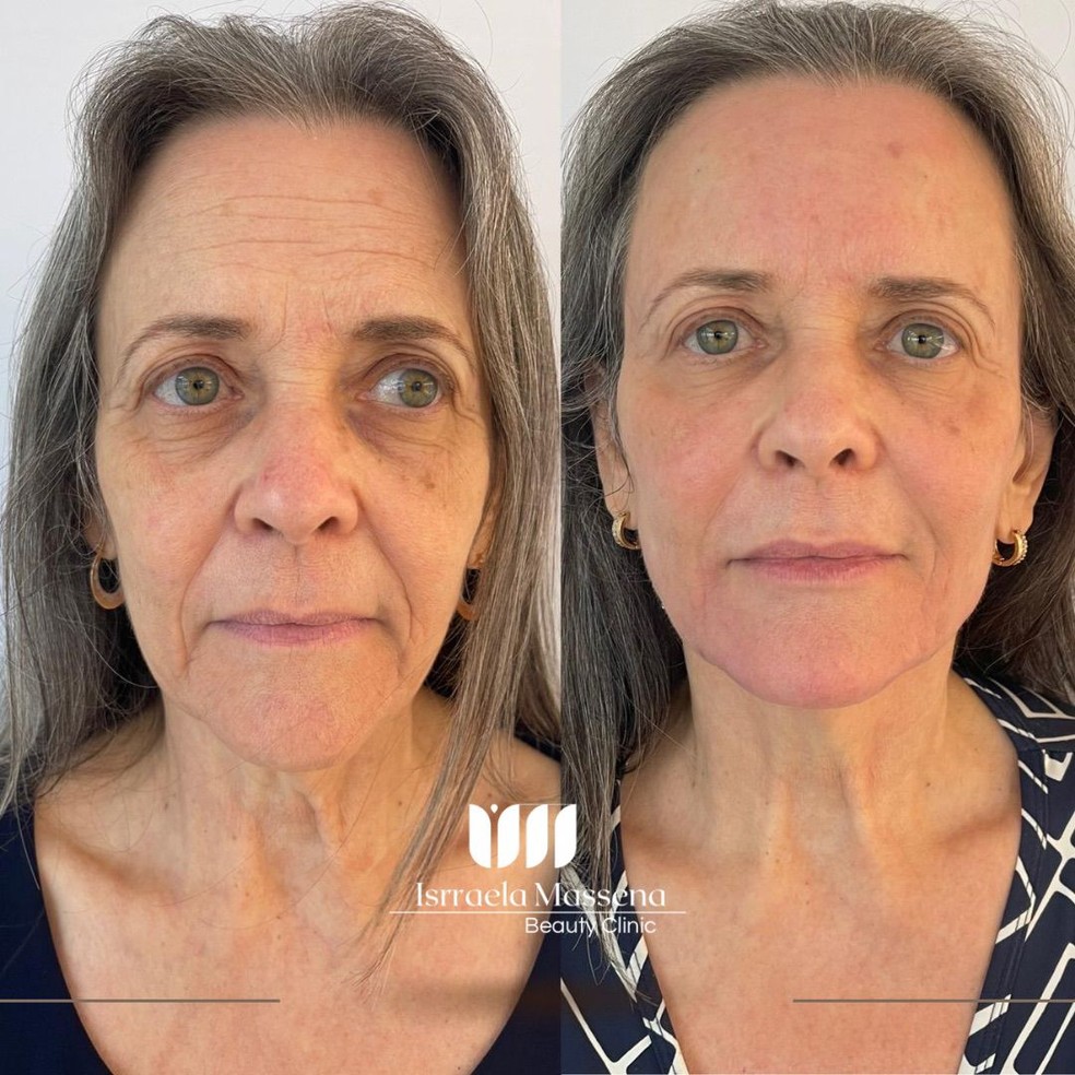 Bioestimuladores de Colágeno: A Solução a Longo Prazo para o Sulco Nasogeniano?