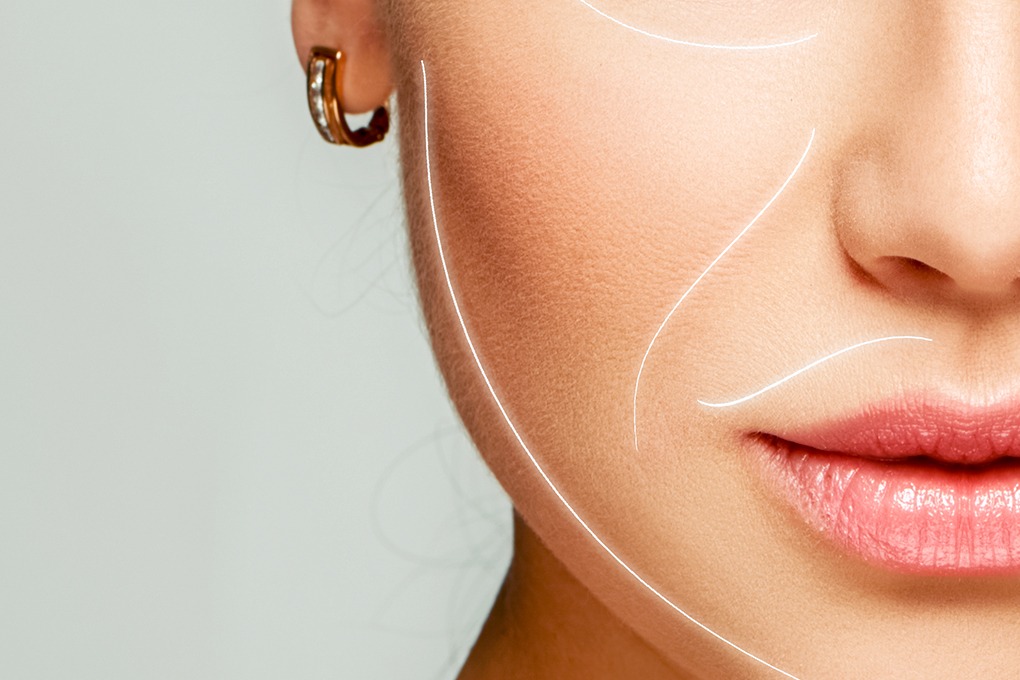 Botox vs. Preenchimento: Qual o Melhor Tratamento para o Bigode Chinês?