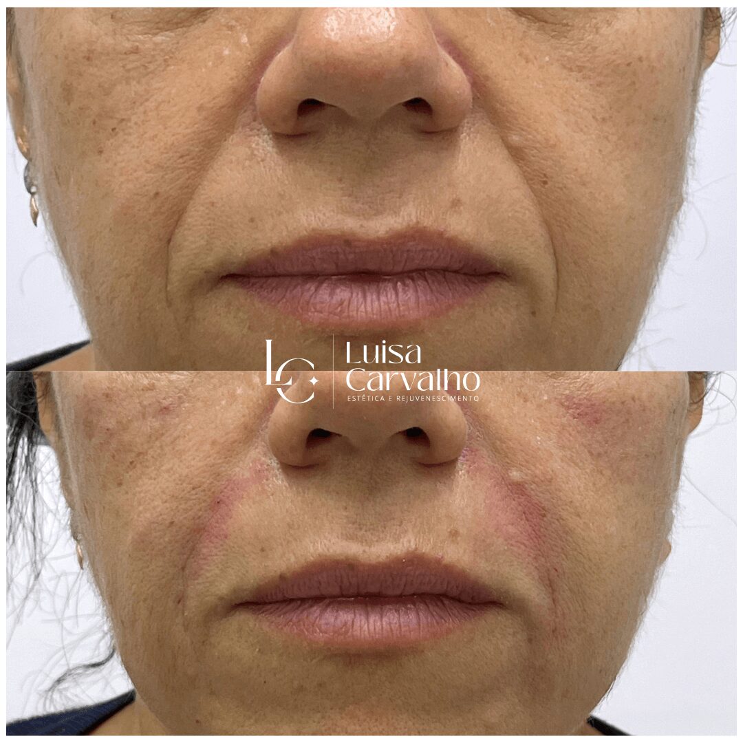 Ácido Hialurônico para Bigode Chinês: Guia Completo e Resultados