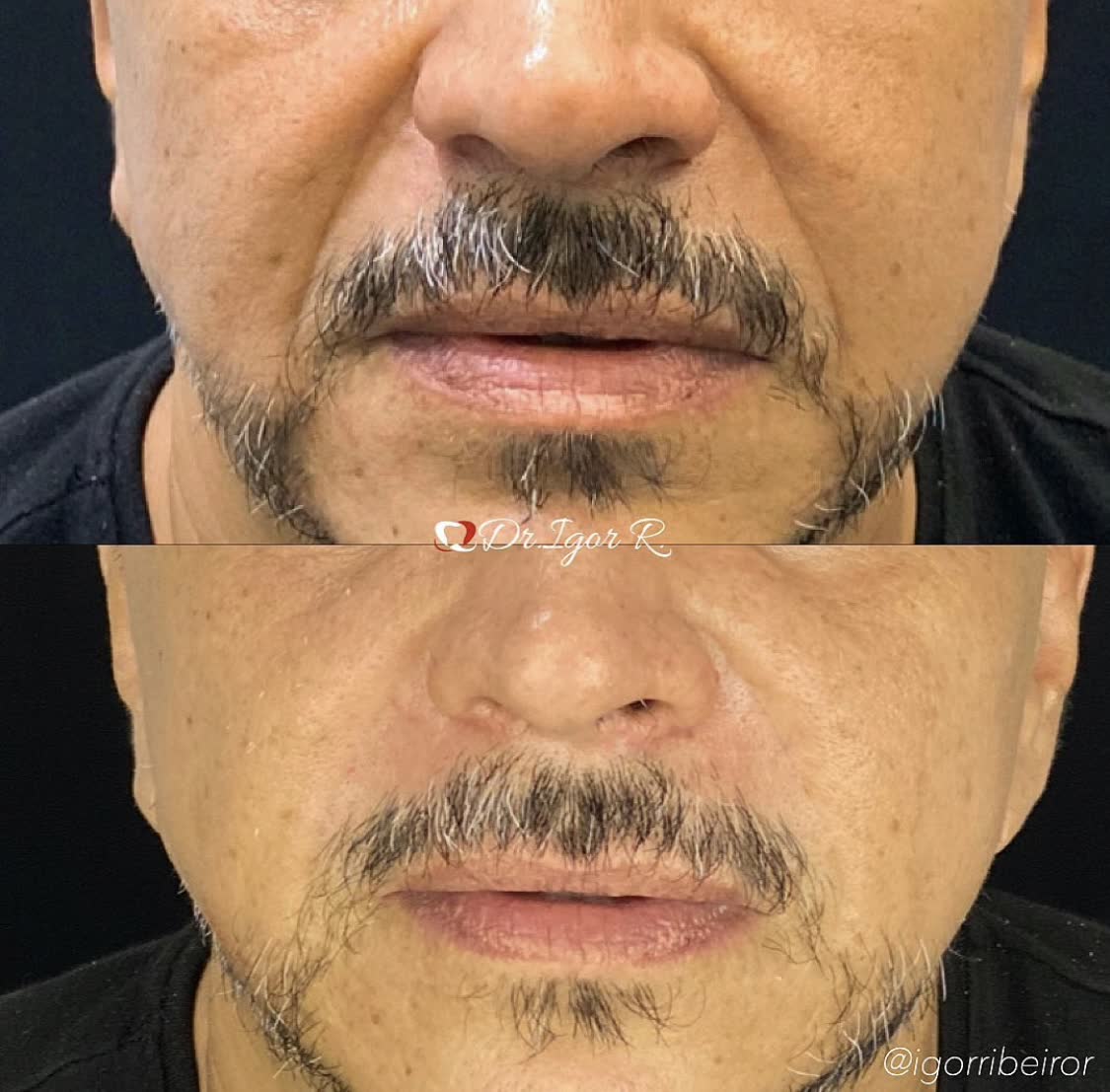 Botox vs. Preenchimento: Qual o Melhor Tratamento para o Bigode Chinês?