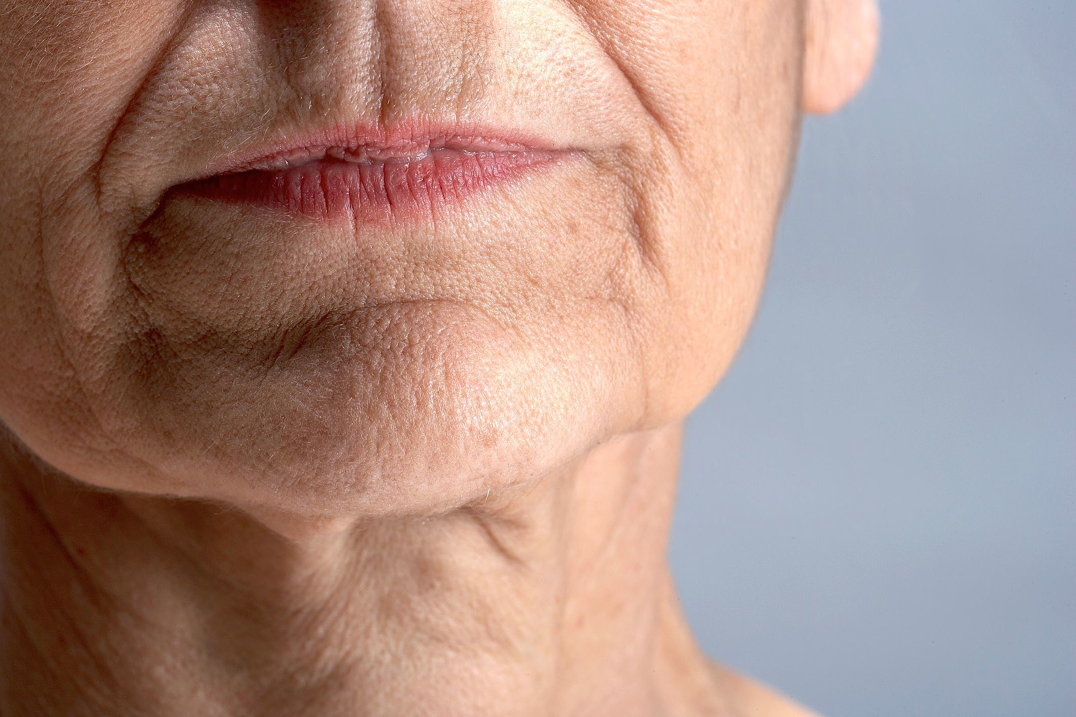 Bioestimuladores de Colágeno: A Solução a Longo Prazo para o Sulco Nasogeniano?