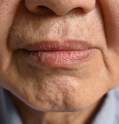 Ácido Hialurônico para Bigode Chinês: Guia Completo e Resultados