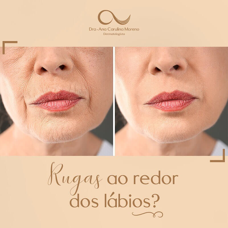 5 ideias de títulos:
1. Código de Barras: Entenda as Causas e os Tratamentos Mais Eficazes
2. Guia Completo: Como Prevenir e Tratar as Rugas ao Redor da Boca
3. Skinbooster vs. Preenchimento: Qual o Melhor para o Código de Barras?
4. Bioestimuladores de Colágeno: A Solução Natural para Rugas Periorais
5. Dicas de Skincare para Combater o Código de Barras