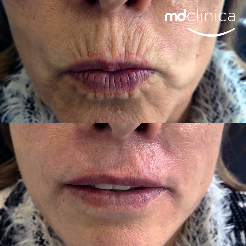 código de barras rugas