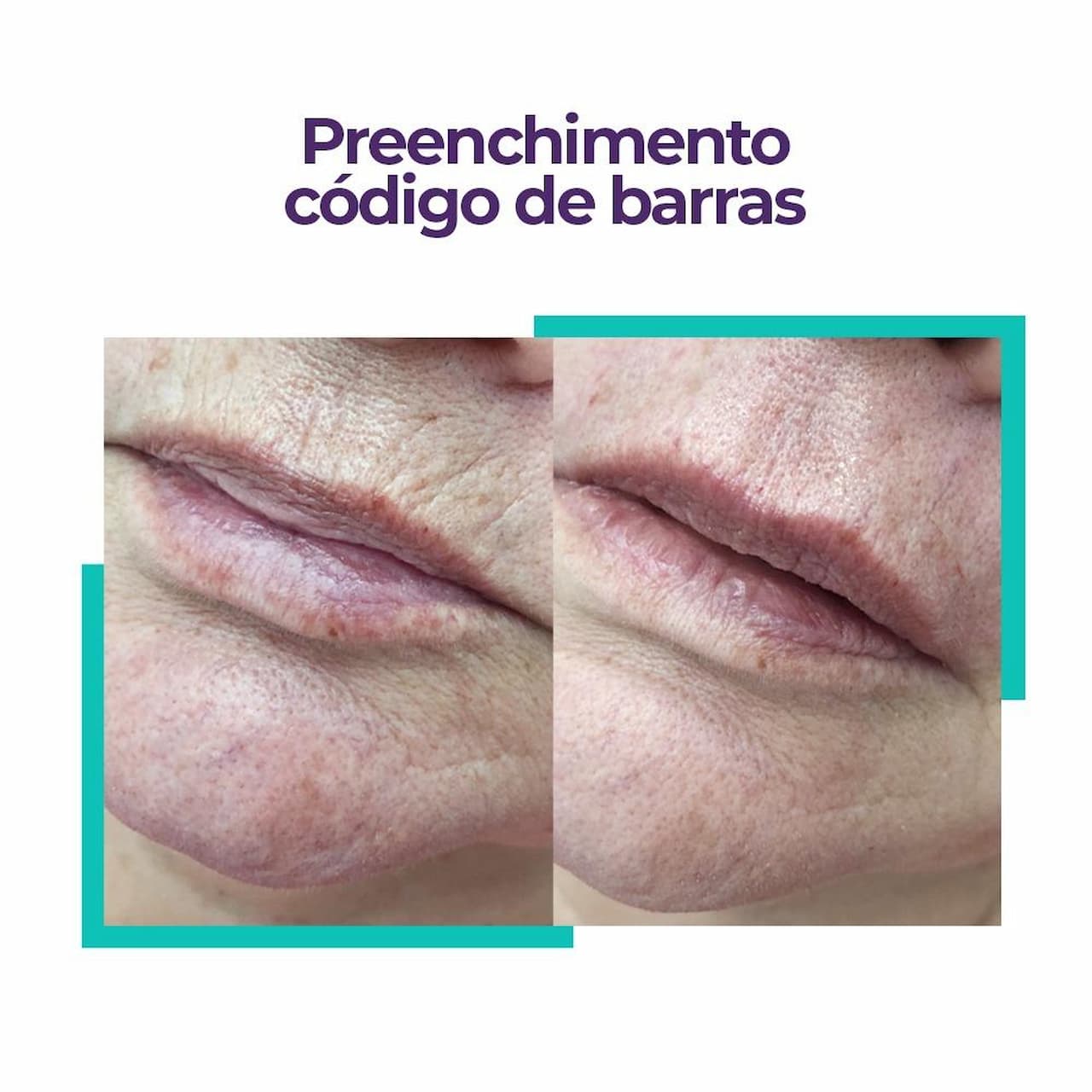 5 ideias de títulos:
1. Código de Barras: Entenda as Causas e os Tratamentos Mais Eficazes
2. Guia Completo: Como Prevenir e Tratar as Rugas ao Redor da Boca
3. Skinbooster vs. Preenchimento: Qual o Melhor para o Código de Barras?
4. Bioestimuladores de Colágeno: A Solução Natural para Rugas Periorais
5. Dicas de Skincare para Combater o Código de Barras