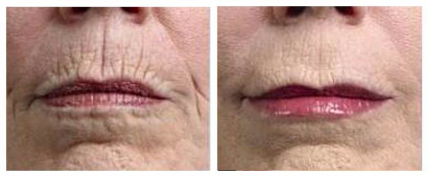 5 ideias de títulos:
1. Código de Barras: Entenda as Causas e os Tratamentos Mais Eficazes
2. Guia Completo: Como Prevenir e Tratar as Rugas ao Redor da Boca
3. Skinbooster vs. Preenchimento: Qual o Melhor para o Código de Barras?
4. Bioestimuladores de Colágeno: A Solução Natural para Rugas Periorais
5. Dicas de Skincare para Combater o Código de Barras