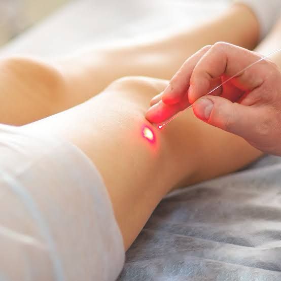 Benefícios e Cuidados Essenciais Antes e Depois; Comparativo: Endolaser vs. Lipoaspiração para Contorno Corporal