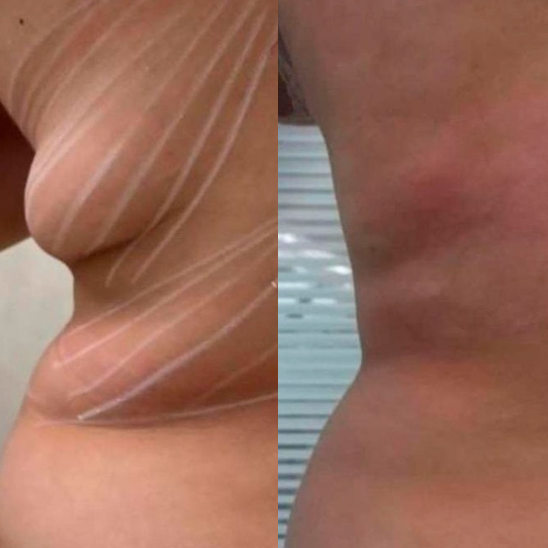 Benefícios e Cuidados Essenciais Antes e Depois; Comparativo: Endolaser vs. Lipoaspiração para Contorno Corporal