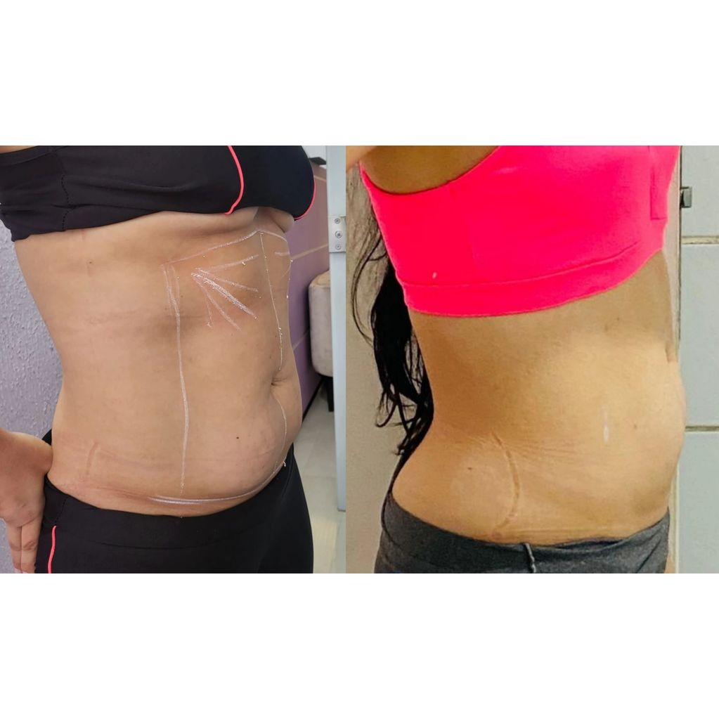 Endolaser para Gordura Localizada: Áreas de Tratamento e Resultados; Endolaser Facial: Como Combater a Flacidez e Rejuvenescer a Pele; Endolaser para Varizes: Guia Completo sobre o Procedimento e Preços; Endolaser: Riscos