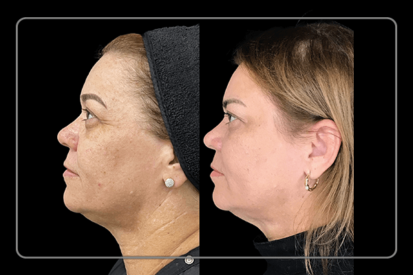 Benefícios e Cuidados Essenciais Antes e Depois; Comparativo: Endolaser vs. Lipoaspiração para Contorno Corporal