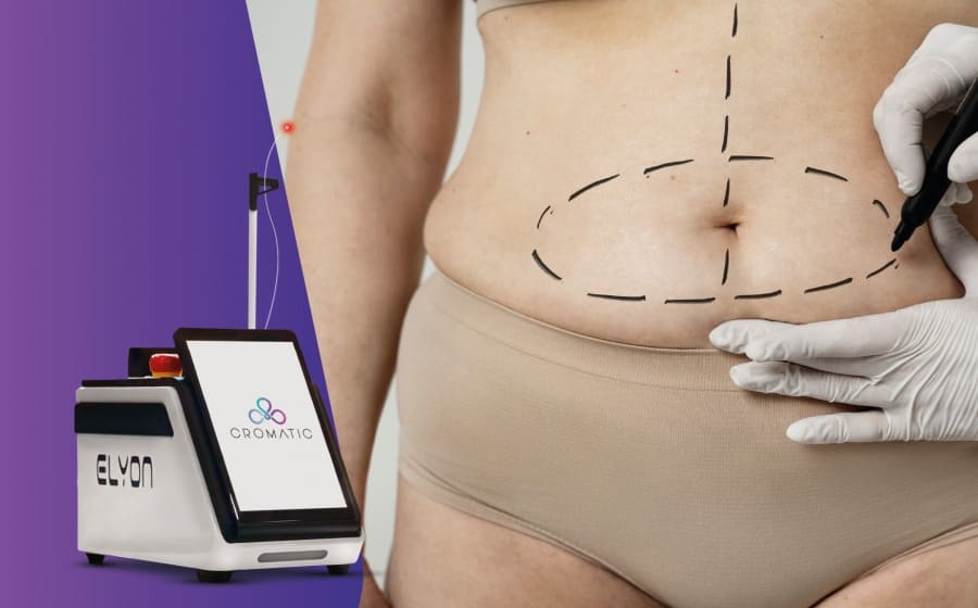 Benefícios e Cuidados Essenciais Antes e Depois; Comparativo: Endolaser vs. Lipoaspiração para Contorno Corporal