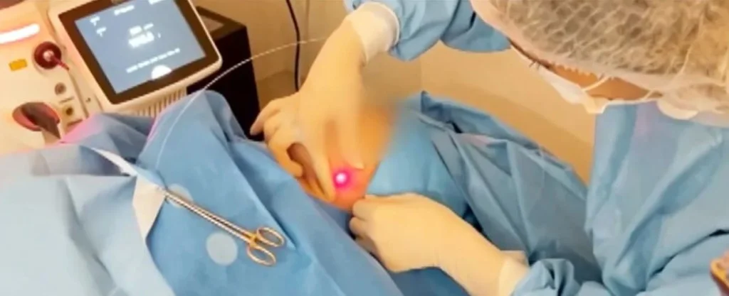 Benefícios e Cuidados Essenciais Antes e Depois; Comparativo: Endolaser vs. Lipoaspiração para Contorno Corporal