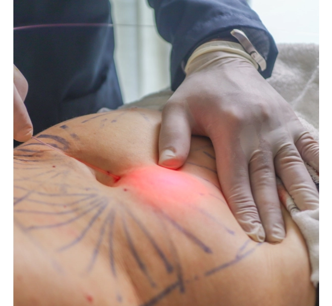 Endolaser para Gordura Localizada: Áreas de Tratamento e Resultados; Endolaser Facial: Como Combater a Flacidez e Rejuvenescer a Pele; Endolaser para Varizes: Guia Completo sobre o Procedimento e Preços; Endolaser: Riscos