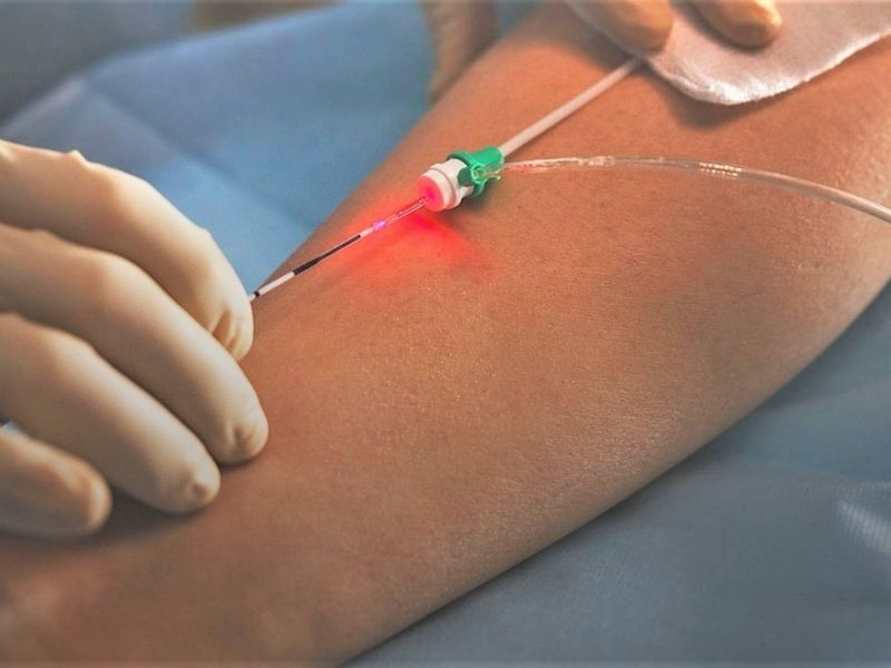 Benefícios e Cuidados Essenciais Antes e Depois; Comparativo: Endolaser vs. Lipoaspiração para Contorno Corporal